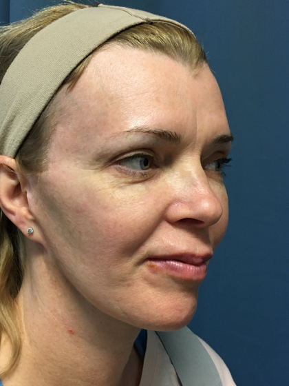 Facelift and Necklift Before & After Patient #13012