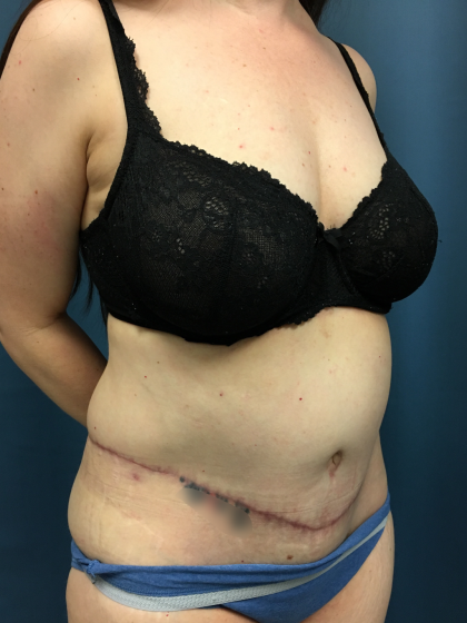 Tummy Tuck Before & After Patient #13015
