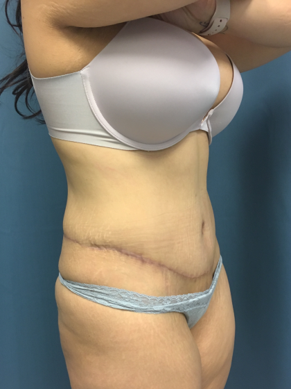 Tummy Tuck Before & After Patient #13016