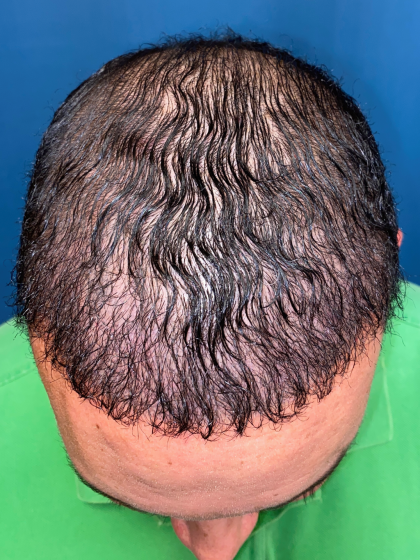 NeoGraft Before & After Patient #12914