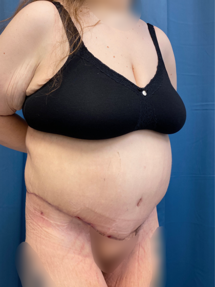 Massive Weight Loss Before & After Patient #13508