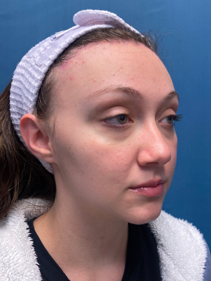 Forehead Reduction Before & After Patient #12935