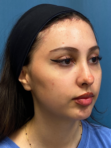 Forehead Reduction Before & After Patient #12936