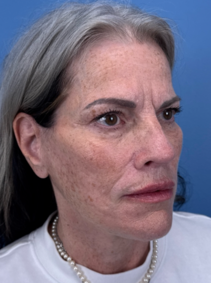 Facelift and Necklift Before & After Patient #12890