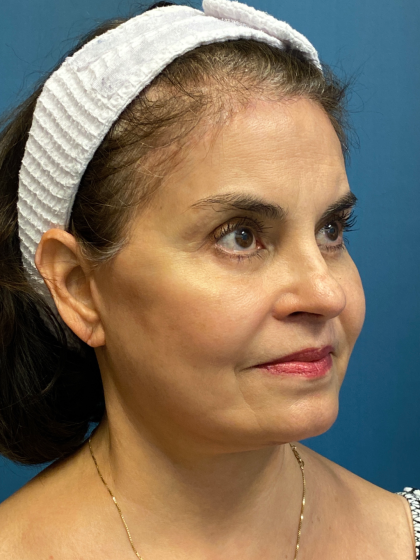 Forehead Reduction Before & After Patient #12937