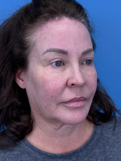 Forehead Reduction Before & After Patient #12938