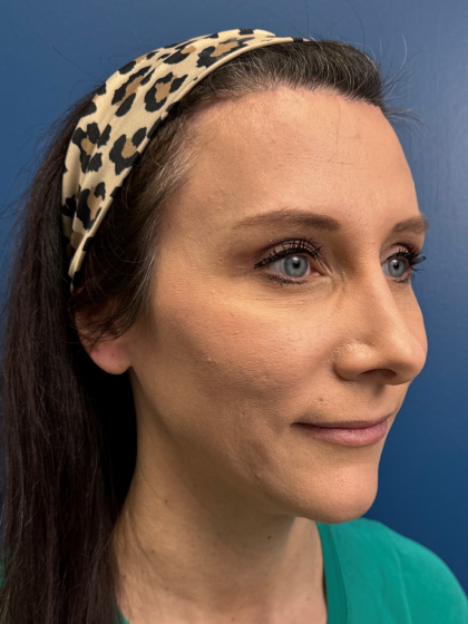 Forehead Reduction Before & After Patient #12940
