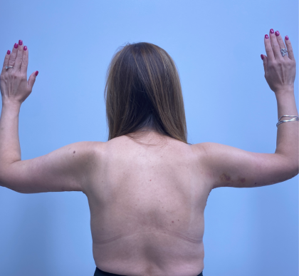 Arm Lift Before & After Patient #12946
