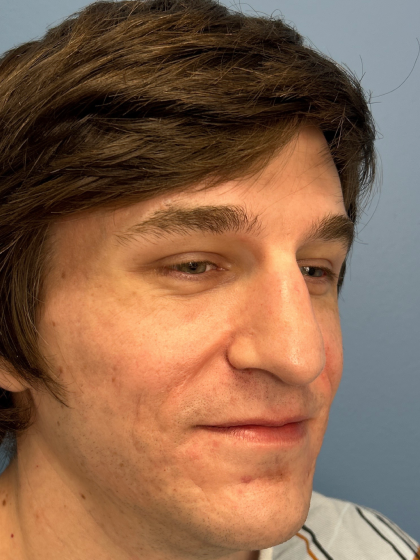 Rhinoplasty Before & After Patient #12901