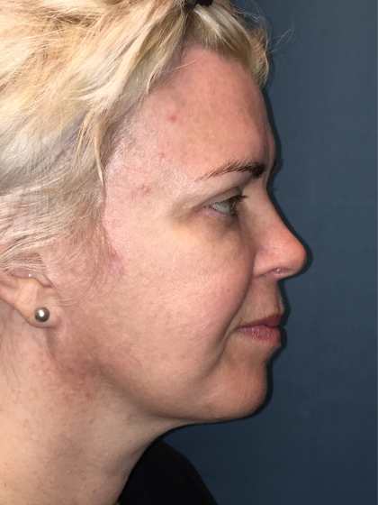 Facelift and Necklift Before & After Patient #13012
