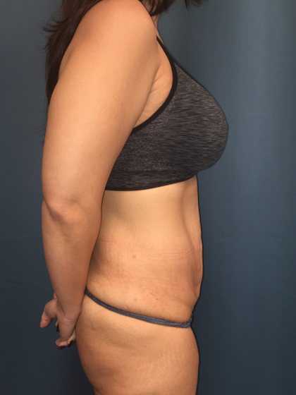 Tummy Tuck Before & After Patient #13016