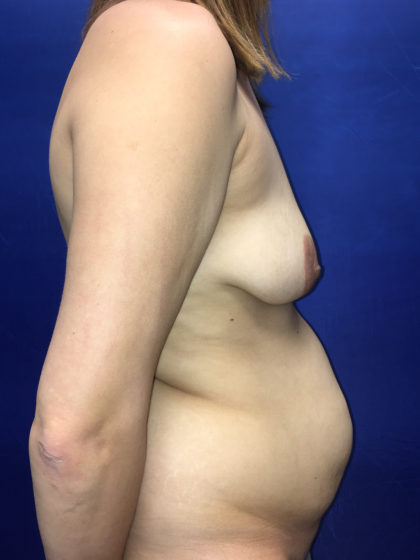 Mommy Makeover Before & After Patient #13078