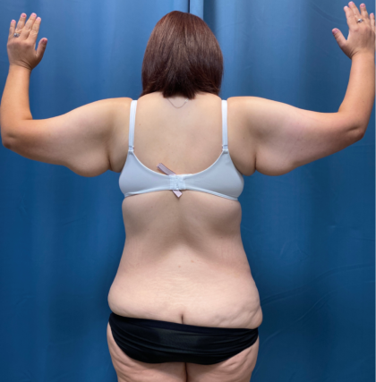 Tummy Tuck Before & After Patient #13485
