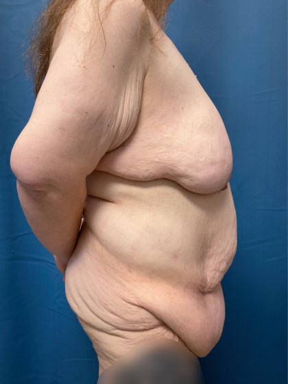 Massive Weight Loss Before & After Patient #13508
