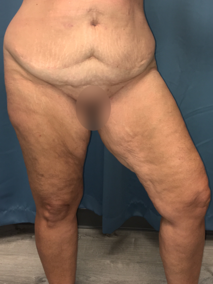 Thigh Lift Before & After Patient #13528