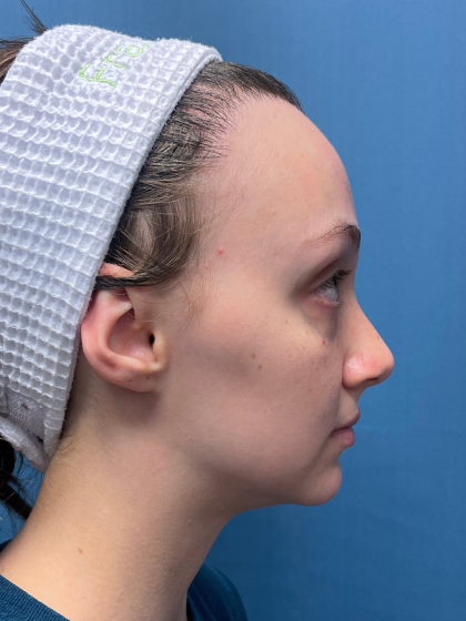 Forehead Reduction Before & After Patient #12935