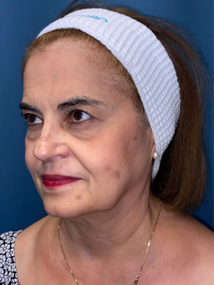 Forehead Reduction Before & After Patient #12937
