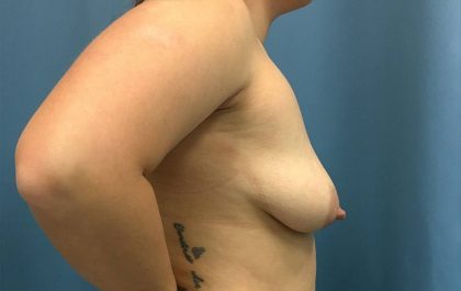 Bilateral Crescent Lift Before & After Patient #13362