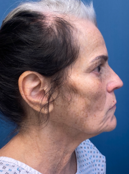 Facelift and Necklift Before & After Patient #12890