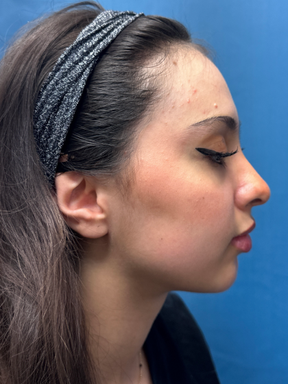 Forehead Reduction Before & After Patient #12936
