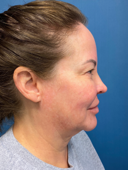 Forehead Reduction Before & After Patient #12938