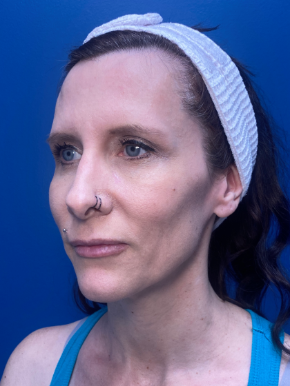 Forehead Reduction Before & After Patient #12940