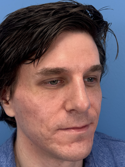 Rhinoplasty Before & After Patient #12901