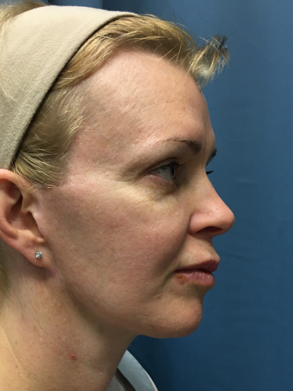 Facelift and Necklift Before & After Patient #13012