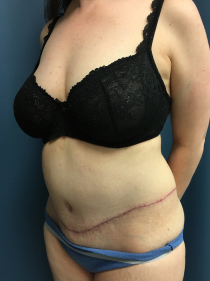 Tummy Tuck Before & After Patient #13015