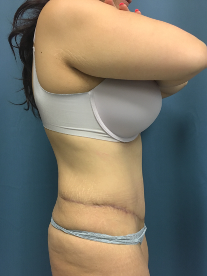 Tummy Tuck Before & After Patient #13016