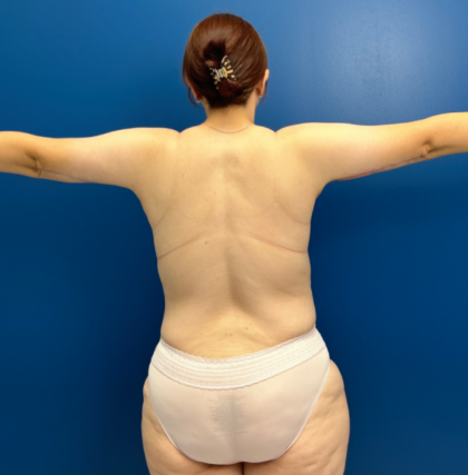 Tummy Tuck Before & After Patient #13485