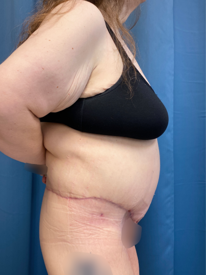 Massive Weight Loss Before & After Patient #13508