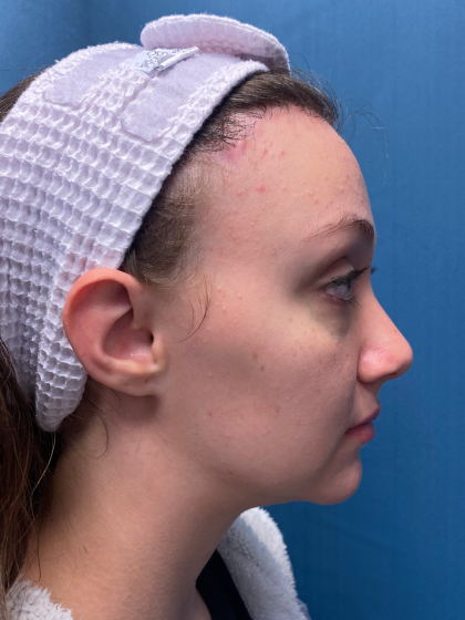 Forehead Reduction Before & After Patient #12935
