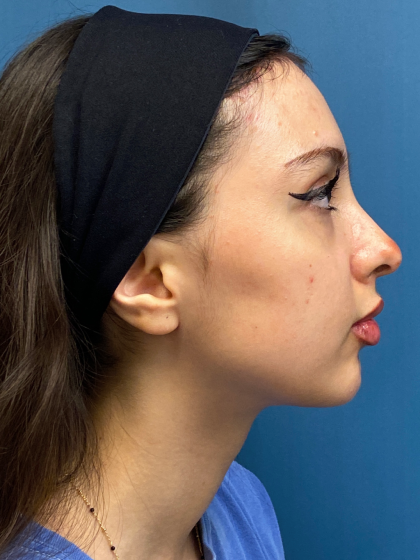 Forehead Reduction Before & After Patient #12936