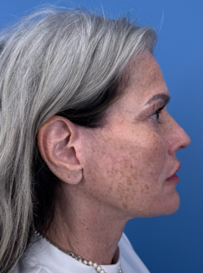 Facelift and Necklift Before & After Patient #12890