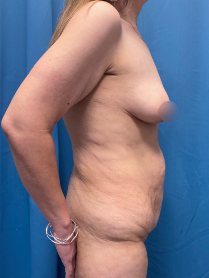 Mommy Makeover Before & After Patient #12947