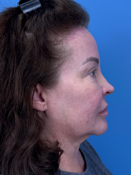 Forehead Reduction Before & After Patient #12938