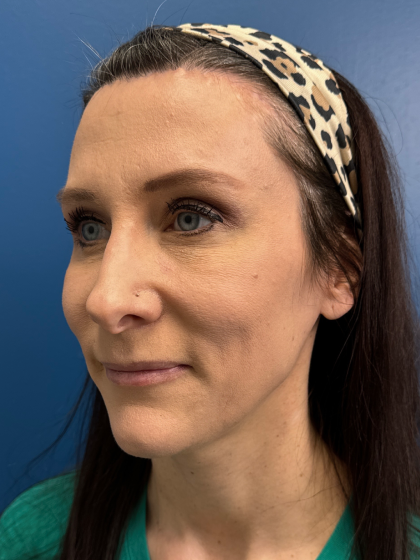 Forehead Reduction Before & After Patient #12940