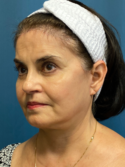 Forehead Reduction Before & After Patient #12937