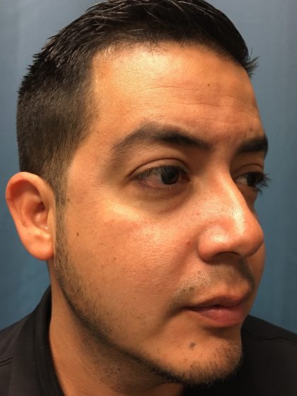 Chin Implant Before & After Patient #13160