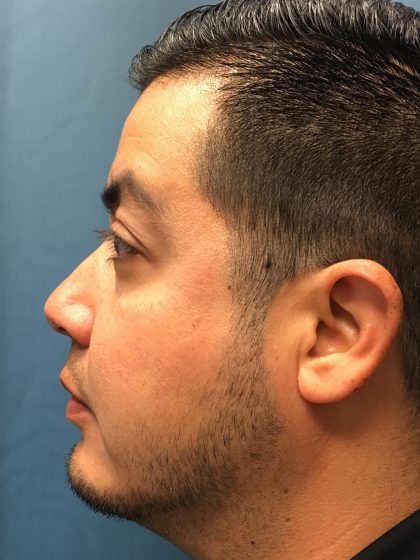 Chin Implant Before & After Patient #13160