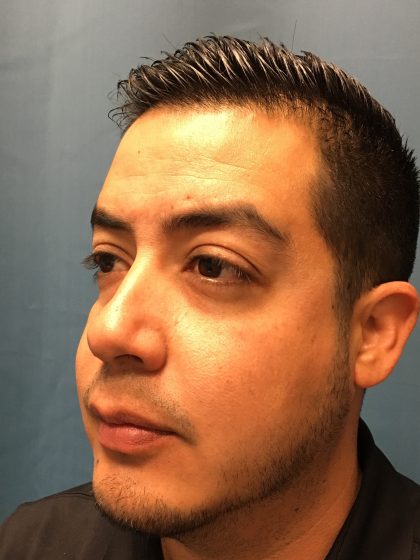 Chin Implant Before & After Patient #13160