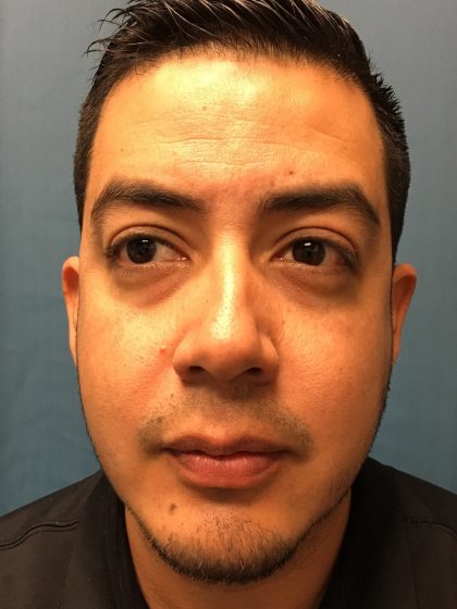 Chin Implant Before & After Patient #13160