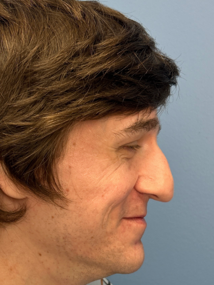 Rhinoplasty Before & After Patient #12901