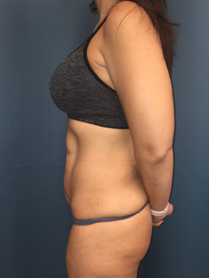 Tummy Tuck Before & After Patient #13016
