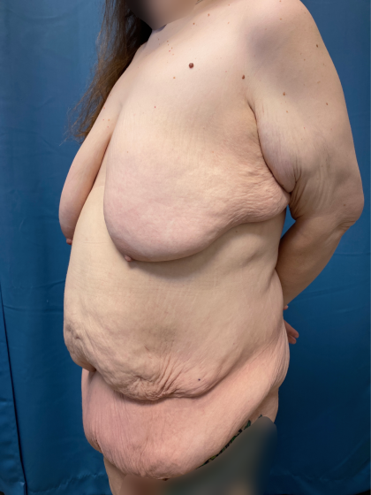 Massive Weight Loss Before & After Patient #13508