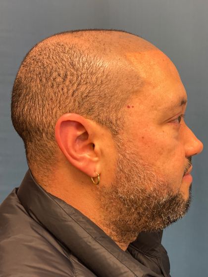 NeoGraft Before & After Patient #12914