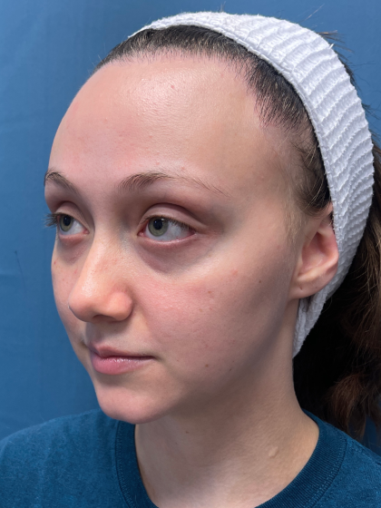 Forehead Reduction Before & After Patient #12935