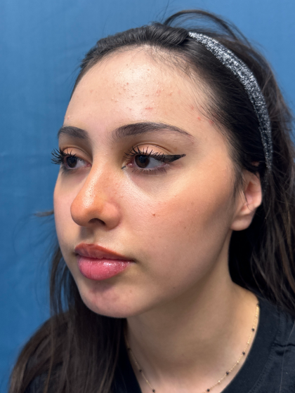 Forehead Reduction Before & After Patient #12936