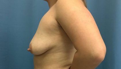 Bilateral Crescent Lift Before & After Patient #13362